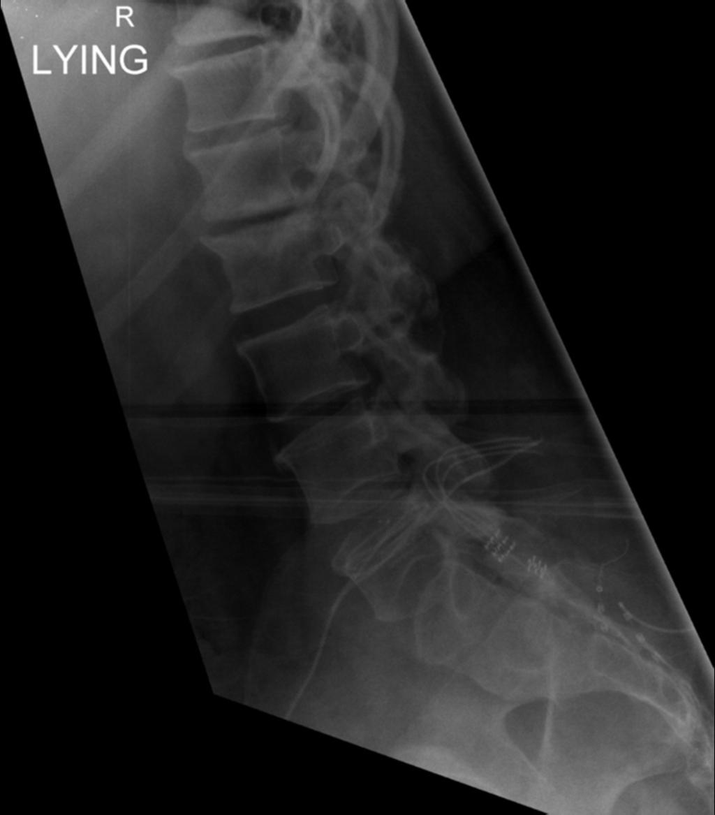 Fig. 3: Figure2A:Lateral radiographs of the lumbar spine. End plate irregularity and sclerosis is present in figure A.