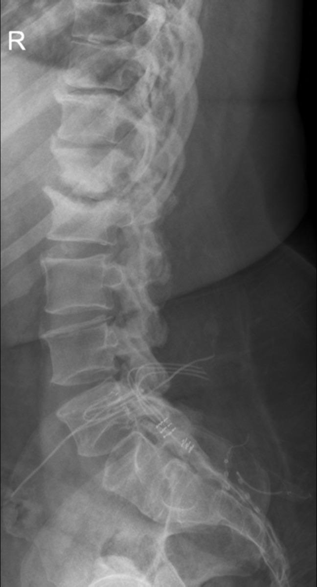 Fig. 4: Figure2B (18 months after Figure 2A):Lateral radiographs of the lumbar spine. End plate irregularity and sclerosis is present in figure A.