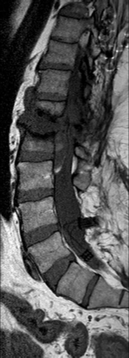 Fig. 16: Figure10: Sagittal T1-W, T2-W and STIR images of the lumbar spine in a patient with Charcot spine, showing fluid signal in the disc space, end plate destruction and sclerosis.