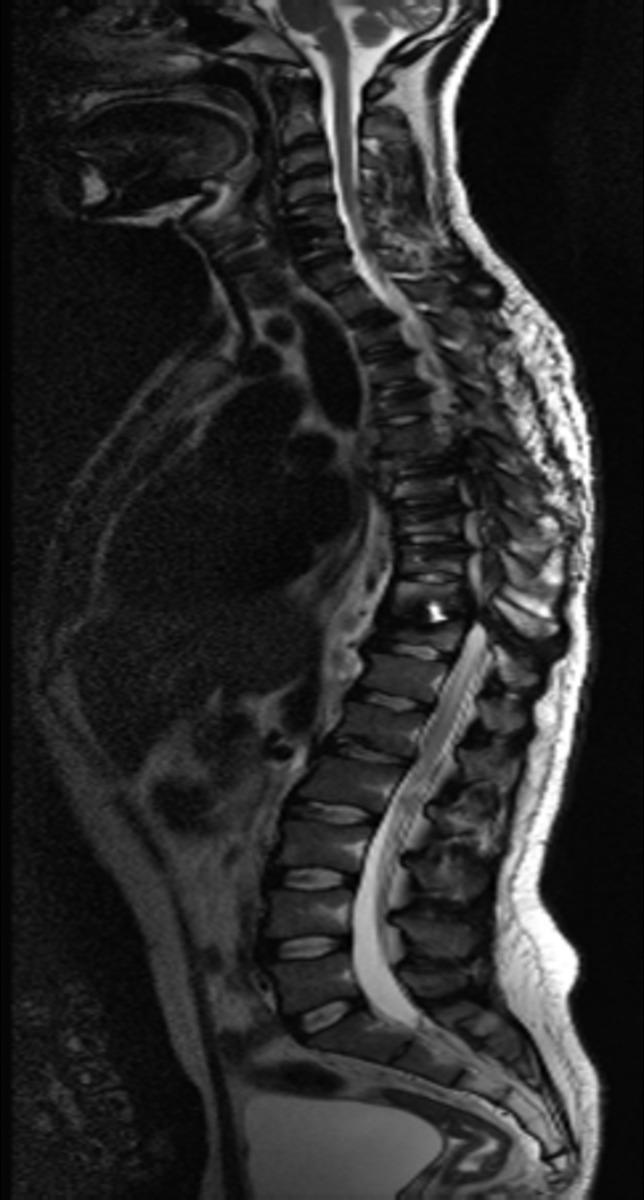 Fig. 21: Figure12A,B,C&D: Adult patient with thoracic spine stabilisation following a complete T2 level cord injury.