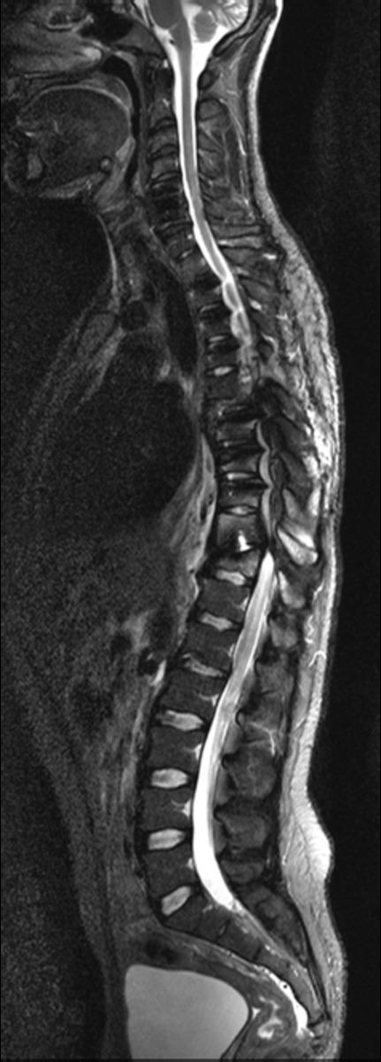 Fig. 22: Figure12A,B,C&D: Adult patient with thoracic spine stabilisation following a complete T2 level cord injury.