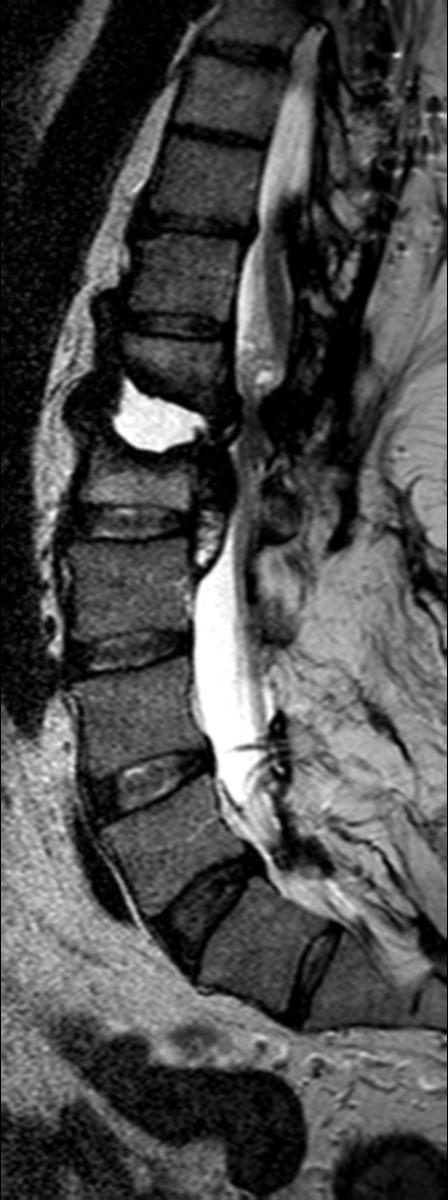 Fig. 15: Figure10: Sagittal T1-W, T2-W and STIR images of the lumbar spine in a patient with Charcot spine, showing fluid signal in the disc space, end plate destruction and sclerosis.