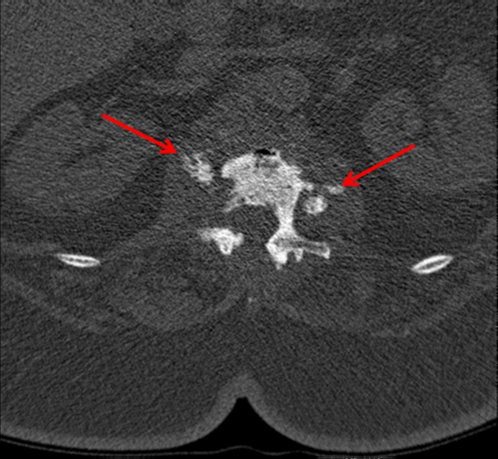 Fig. 8: Figure5: Axial CT image showing calcific