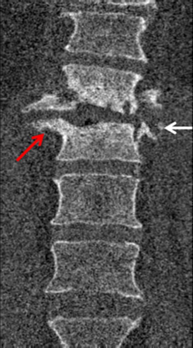 Fig. 12: Figure8: Coronal CT reconstruction showing the formation of large marginal osteophytes