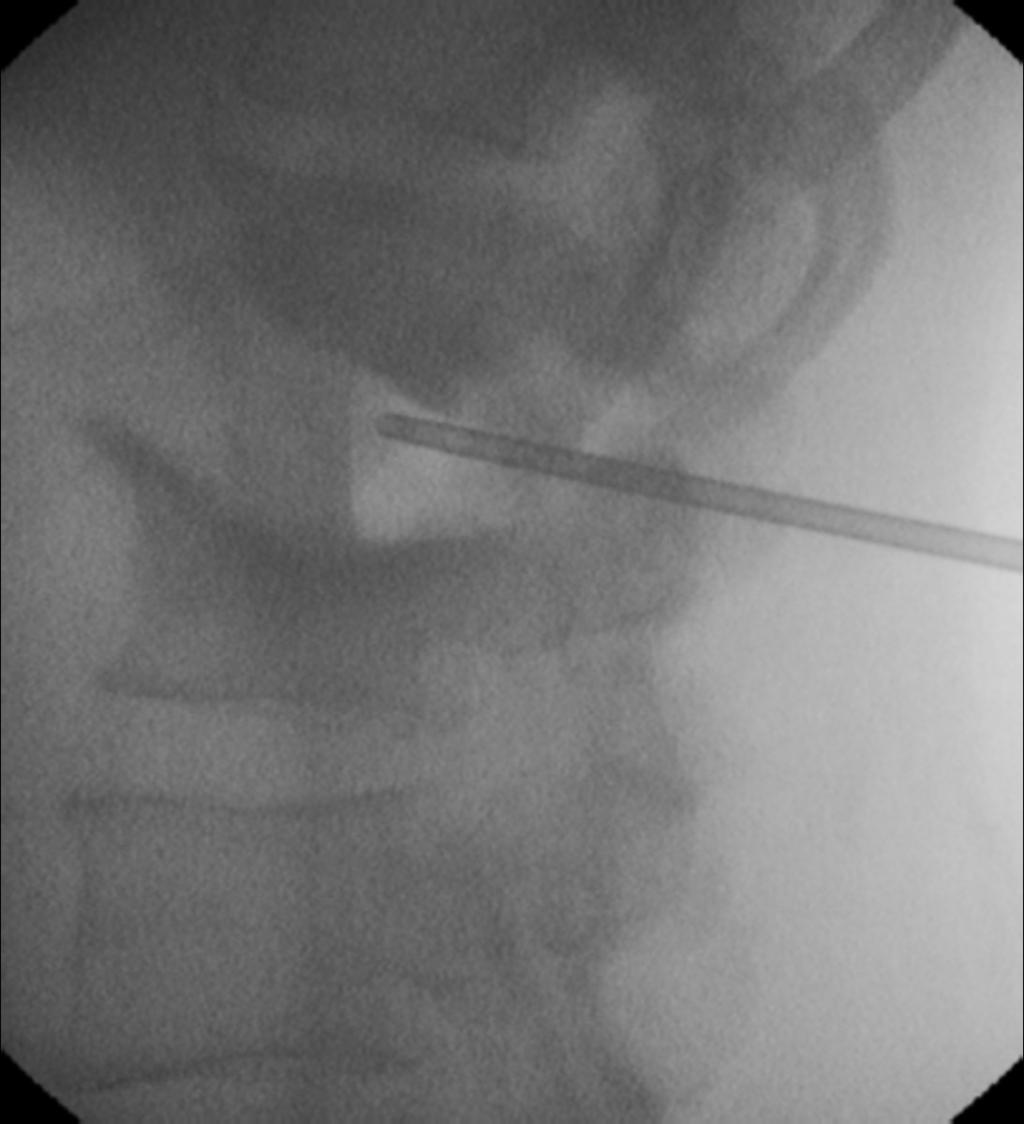 Fig. 24: Figure13: Lateral view showing a fluoroscopic-guided aspiration / biopsy of the disc space