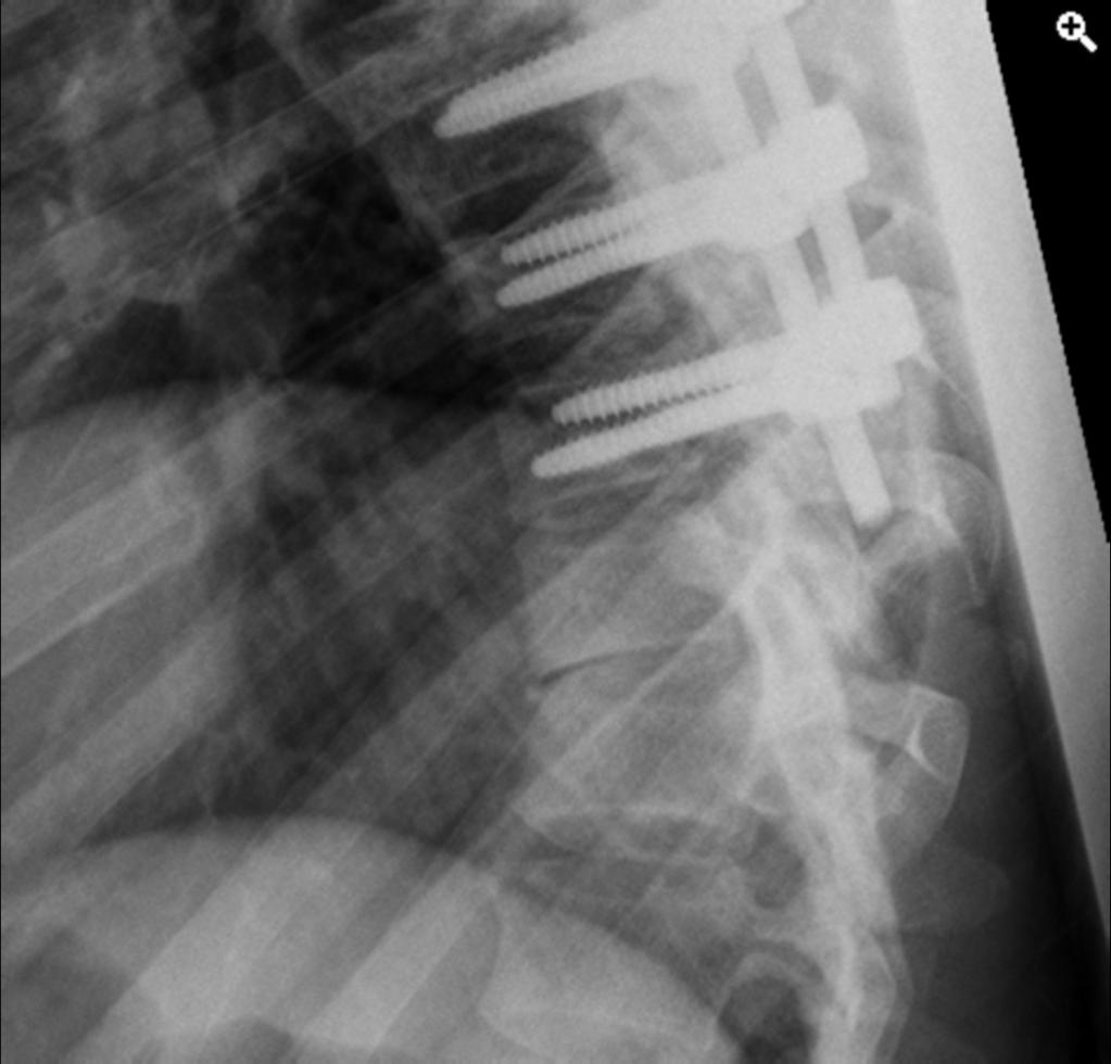 Fig. 2: Figure1B:Lateral Radiographs of the thoraco-lumbar spine showing increasing kyphosis over a 6 month period in a patient with Charcot spine,