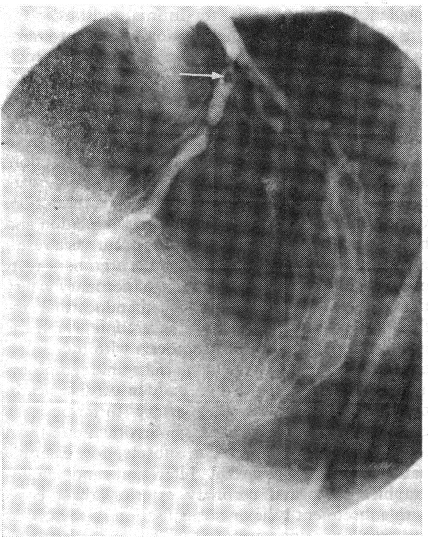Coronary artery thrombosis with unstable angina Fig. 2 Left anterior oblique view showing in left anterior descending coronary artery distal to high-grade stenosis.