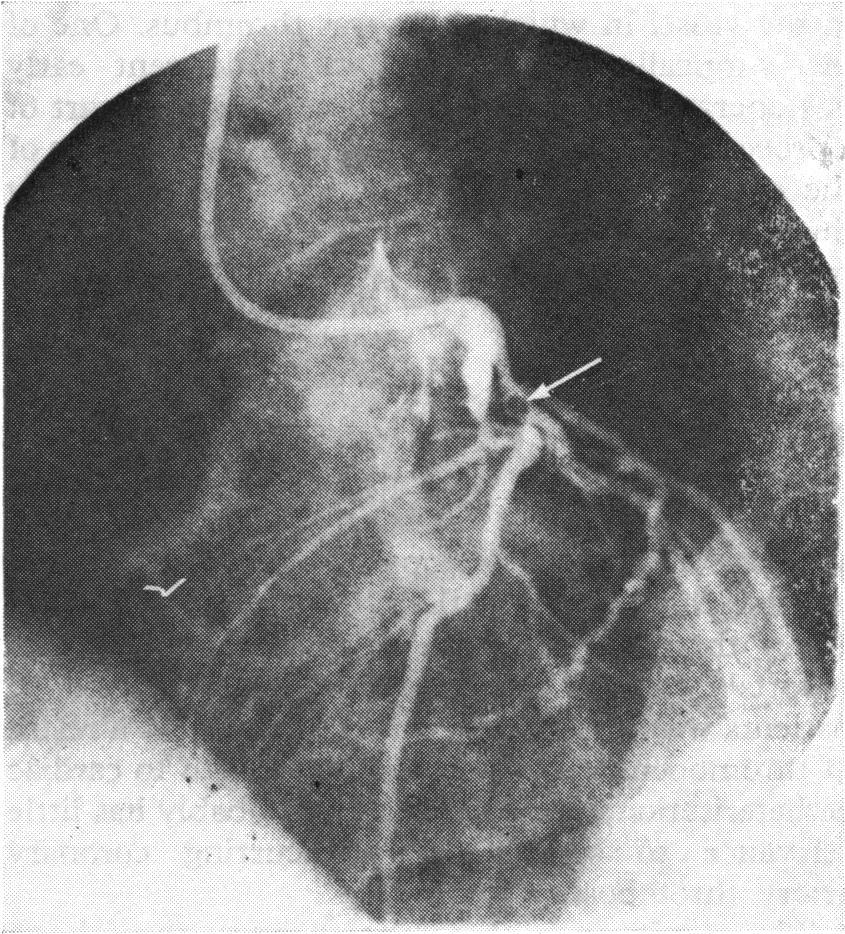 The third patient died suddenly, presumably from an arrhythmic event, 24 hours after catheterisation. Angiography had documented a proximal right Fig.
