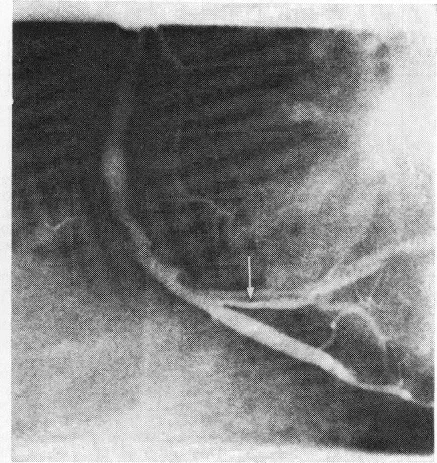414 coronary artery, which was confirmed at the time of necropsy. Twelve patients underwent saphenous vein bypass graft surgery with a mean of 2-4 grafts per patient.