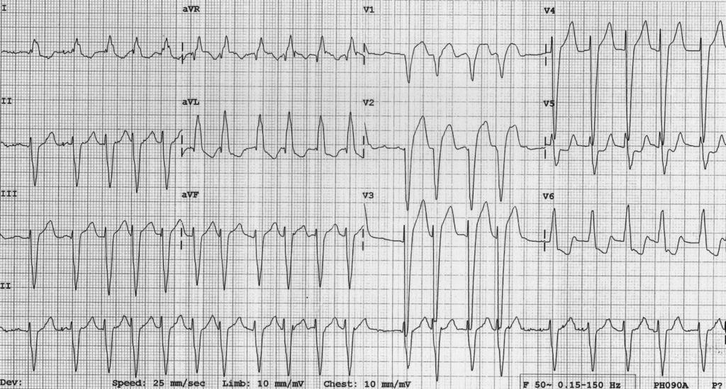 DCM AF and LBBB E