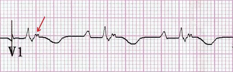 Arrhythmogenic Right Ventricular Cardiomyopathy Epsilon wave (most specific finding, seen in 30% of patients) T wave inversions in V 1 -V 3 (85% of patients)