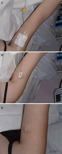 Figure 3. A) P.A.S. Port sited B) P.A.S. Port in upper arm needle in situ C) P.A.S. Port protective dressing and needle in situ.