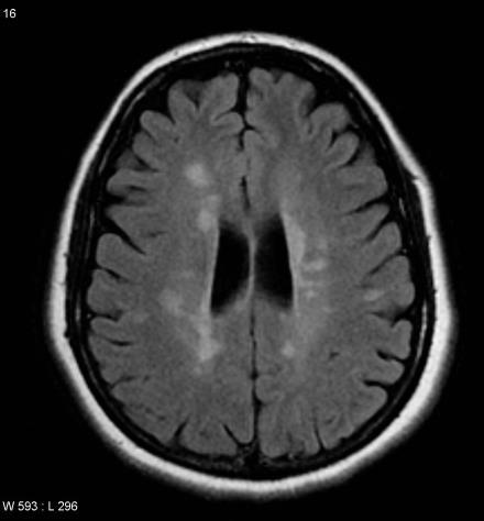 MS changes on MRI MS and cognition MS is a disease of the white matter, so tends to affect cognitive processes that