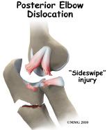 The most common elbow dislocations are associated with sports such as gymnastics, cycling, rollerblading, or skateboarding. intense until the arm is relocated.