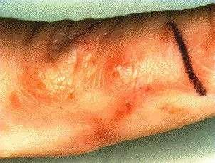 Scabies - burrws n a finger Ndules may develp. These ccur particularly at the elbws, anterir axillary flds, penis, and scrtum. They are firm, dull red r brwn, and may be very itchy.