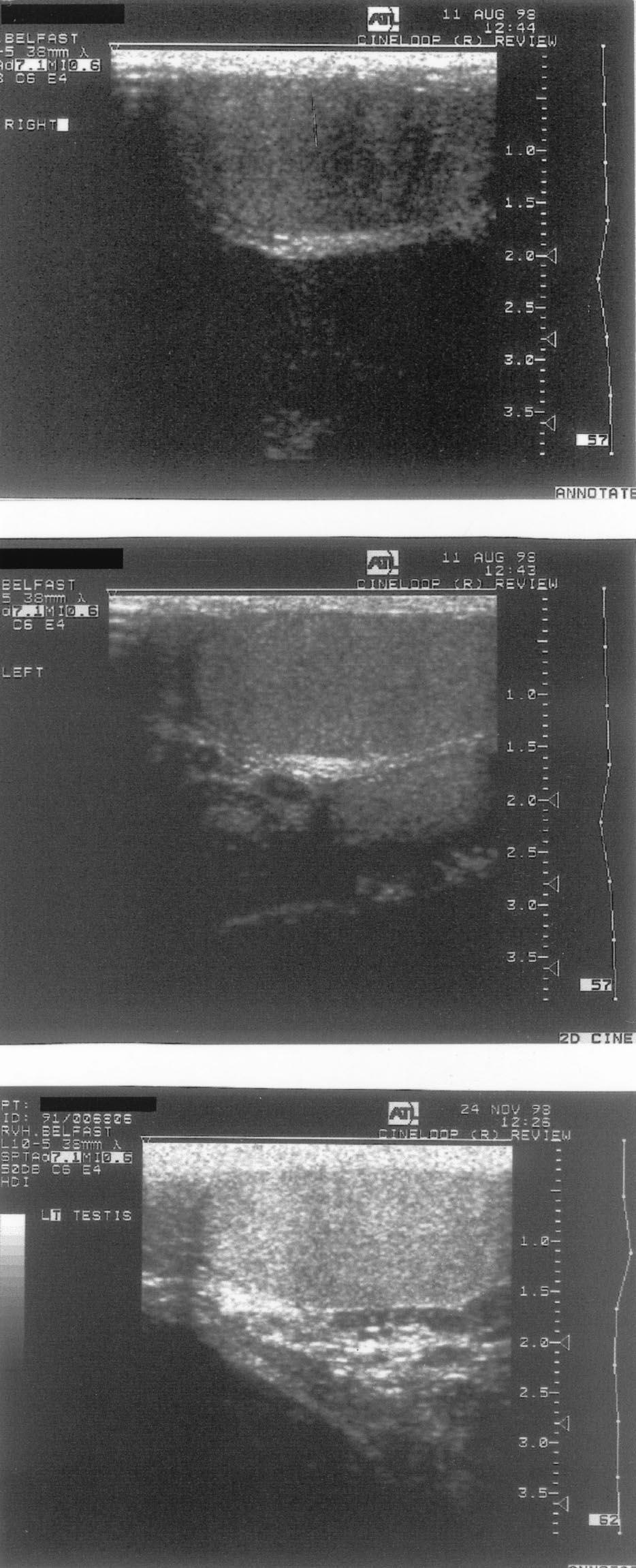 FIGURE 2 Ultrasound appearances of both testes before biopsy and of the left testis after biopsy in a patient with nonobstructive azoospermia.
