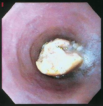 Esophageal Food Bolus Impaction Disimpaction should not be delayed beyond 12-24 hours Bypass obstruction with endoscope if possible Assess cause of obstruction and angle at GE junction Avoid blindly
