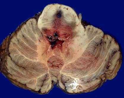 Duret hemorrhage The end result of temporal medial lobe ( transtentorial) herniation is compression of the brainstem (midbrain and pons) and stretching of small arterial branches to cause Duret