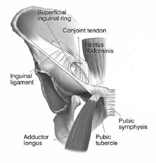 Intraarticular hip problem Impingement/labral tear Osteoarthritis Femoral neck stress fracture Extraarticular hip problem