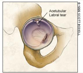 Hip labral tear http://www.aafp.org/afp/1999/1015/p1687.html What s your leading diagnosis? 1.