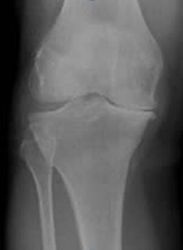 Radiographic findings in osteoarthritis 1. Joint space narrowing 2. Subchondral sclerosis 3. Osteophytosis http://www.hopkins-arthritis.