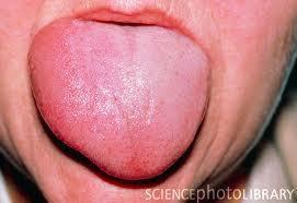 Reactions Anaphylactoid reactions Rash Urticaria Bronchospasm Hypotension Shock Angioedema Angioedema: Rare (1-2%) but potentially life-threatening Angioedema assessment: Check tongue