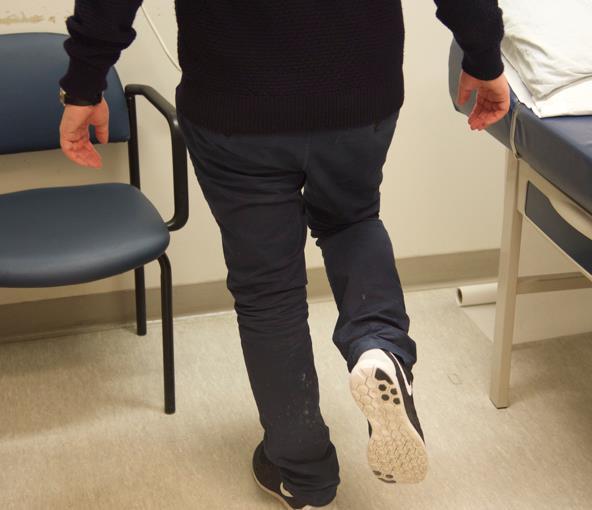 Physical Exam Trendelenburg Patient stands on affected limb Test is positive if contralateral hemi pelvis