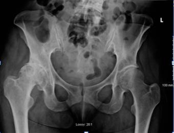 Review: Common adult hip problems (ahp)