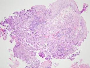 poorly differentiated NSCLC Pathology Recommendation 9 For small biopsies and cytology, we recommend that NSCLC be further classified into a more specific histologic type, such as adenocarcinoma or