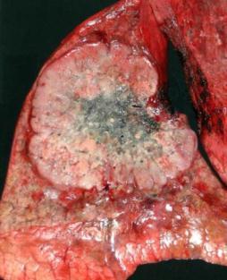 Classification of Lung Carcinoma Important Clinical Inflection Points squamous cell carcinoma