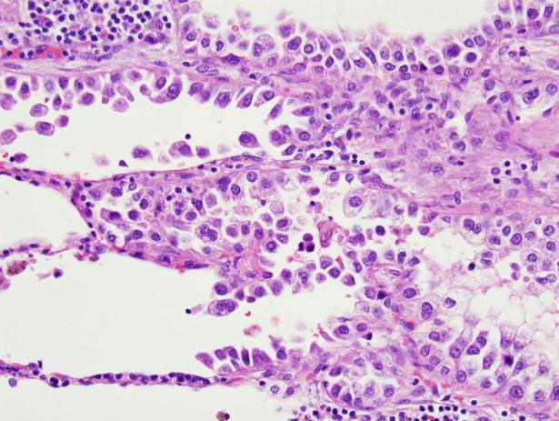 adenocarcinoma with Clara cells and/or type II