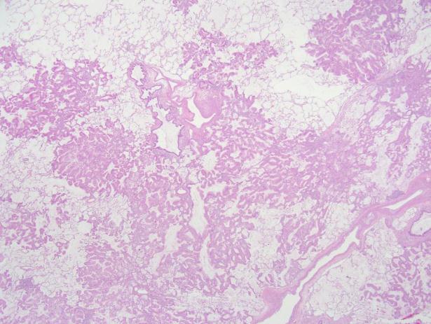 mucinous subtype tall columnar cells, with varying amounts of cytoplasmic mucin, which typically