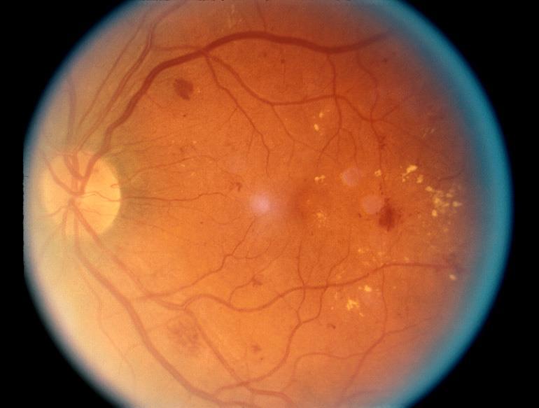 Systems affected Retina