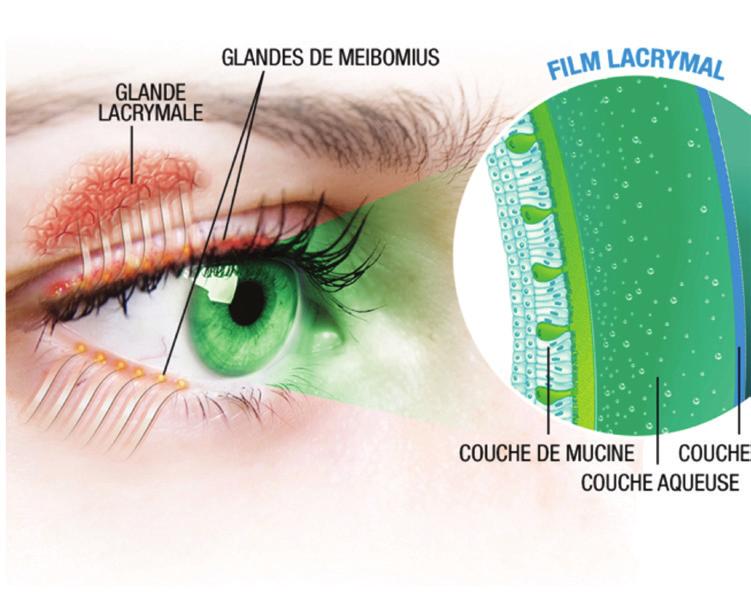 com DRY EYE INFORMATION AND TREATMENTS DÉFINITION Dry eye is a multifactorial disease of the tears and the ocular surface that results in discomfort, visual disturbance and tear film instability.