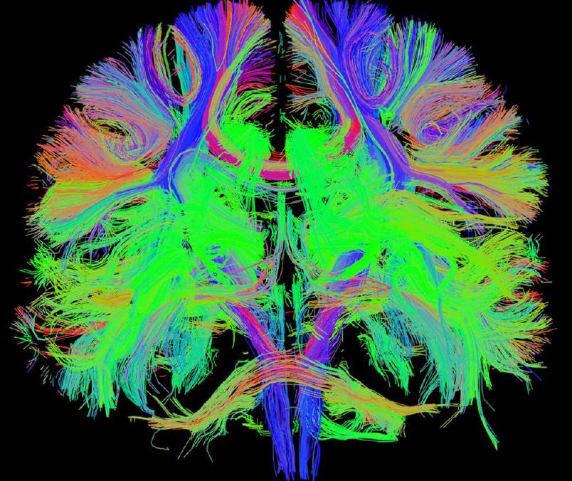 subjects Tractography image