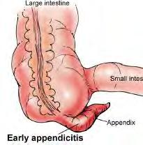 Appendicitis Page 4 xxx00.