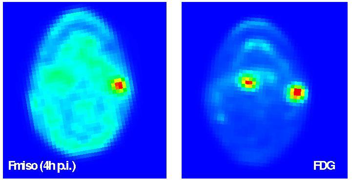 Non-invasive hypoxia PET imaging with 18 F- FMISO: Clinical [ 18 F]-FMISO) selectively binds in hypoxic areas of