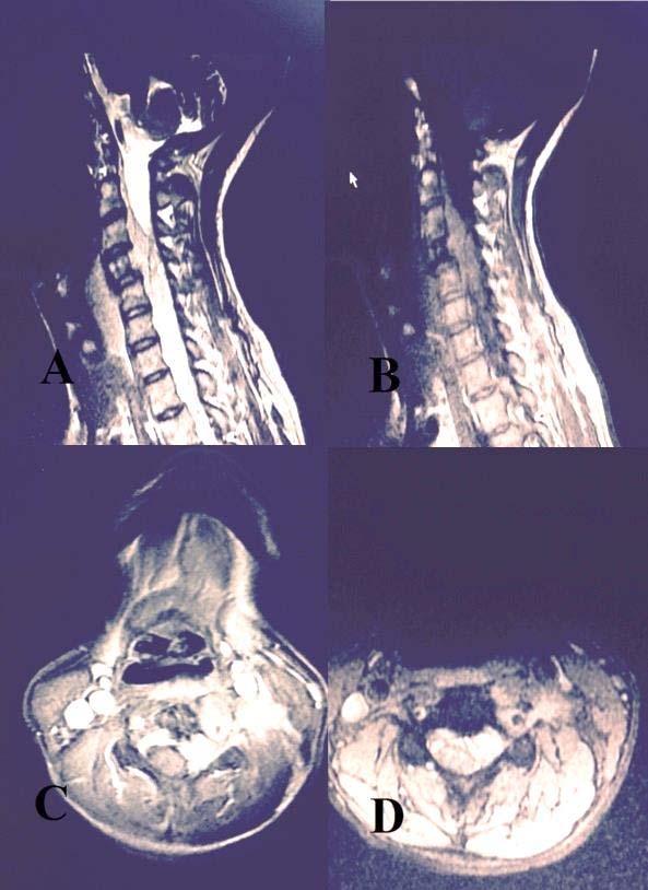 Romanian Neurosurgery (2017) XXXI 1: 85 89 87 Figure 1 A, B,C,D - Mass lesion, compressing the spinal cord by filling the posterior C3-C4-C5 epidural space, that is hyperintense on sagittal