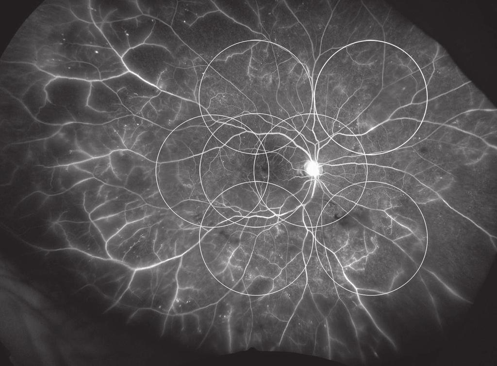 Peripheral non-perfusion Neovascularization Recent research has established the importance of monitoring the retinal periphery (area outside of ETDRS) for early signs of DR.