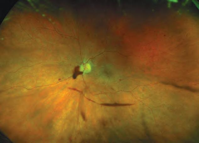 Retinal Hemorrhage is the abnormal bleeding or leakage of the blood vessels in the retina often seen in conditions such as diabetic retinopathy.