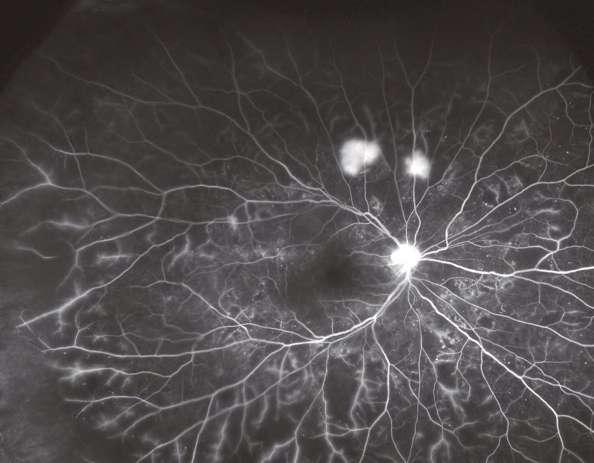 Diabetic Retinopathy Neovascularization is the abnormal