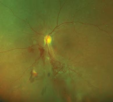 vessels growths at the optic disc and neovascularization