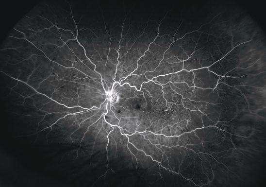 Microaneurysms are focal dilation of the venous end of retinal