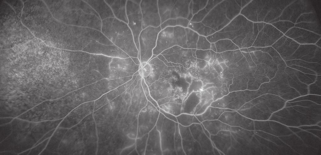 These appear in the retinal vessels as a small round red spot