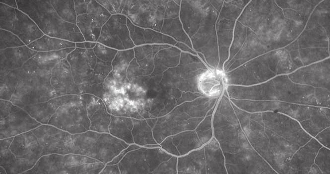 Diabetic Macular Edema (DME) is retinal swelling and cyst formation in the macular area.