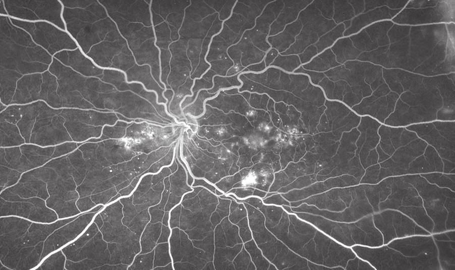 findings have been correlated to traditional FA imaging methods macular edema and signs of macular