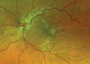 1 Diabetic Retinopathy Exudates are proteins or lipids that leak from blood vessels into the
