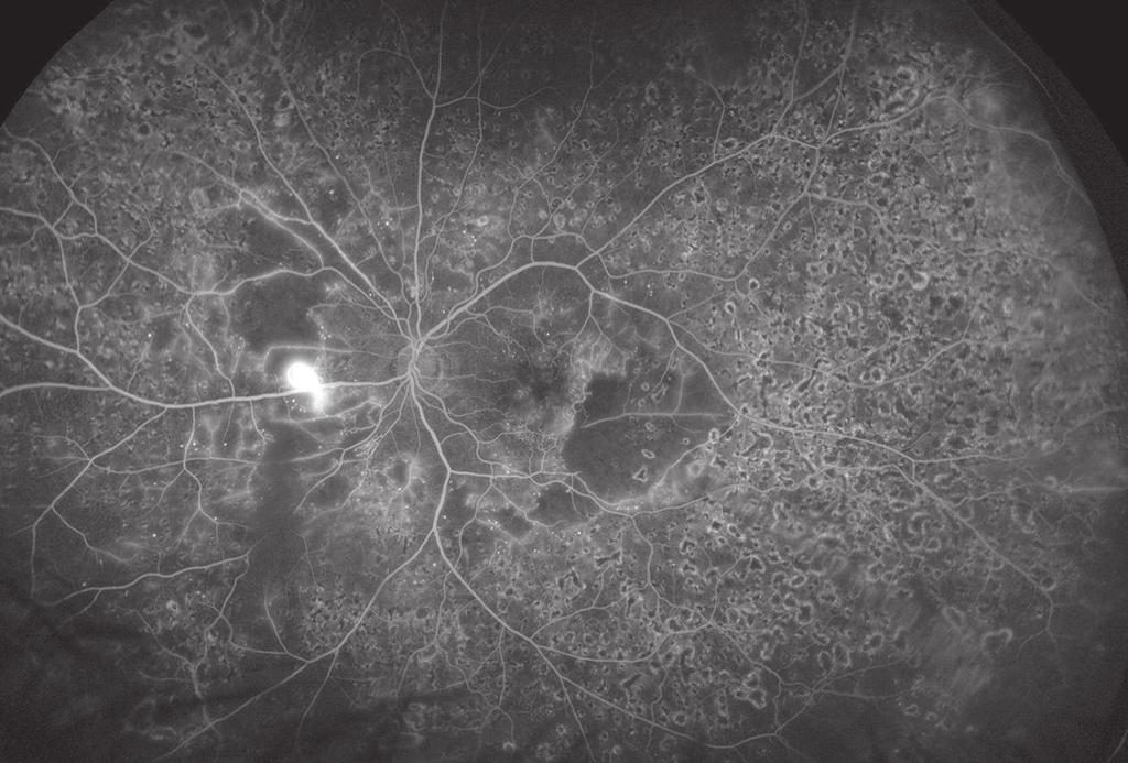 Intraretinal Microvascular Abnormalities (IRMA) Diabetic Retinopathy is a development of abnormal blood vessels with tiny