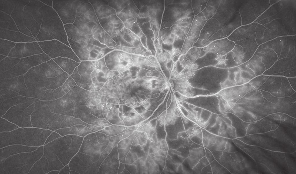 They occur in hypertensive and diabetic retinopathy, when blood is unable to flow through the normal capillaries, resulting in