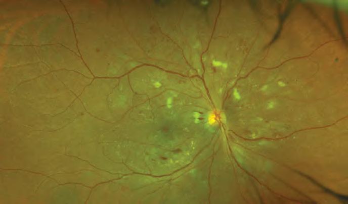 PDR IRMA PDR Cotton wool spots Hard exudates Hemorrhages Non-perfusion Pan-Retinal Photocoagulation (PRP) is used to treat the